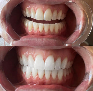 Atown Grillz Teeth Whitening (BLEACHING TRAYS)