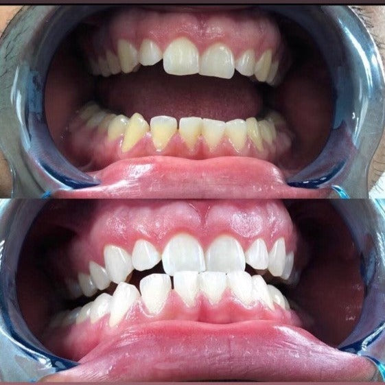 Atown Grillz Teeth Whitening (BLEACHING TRAYS)